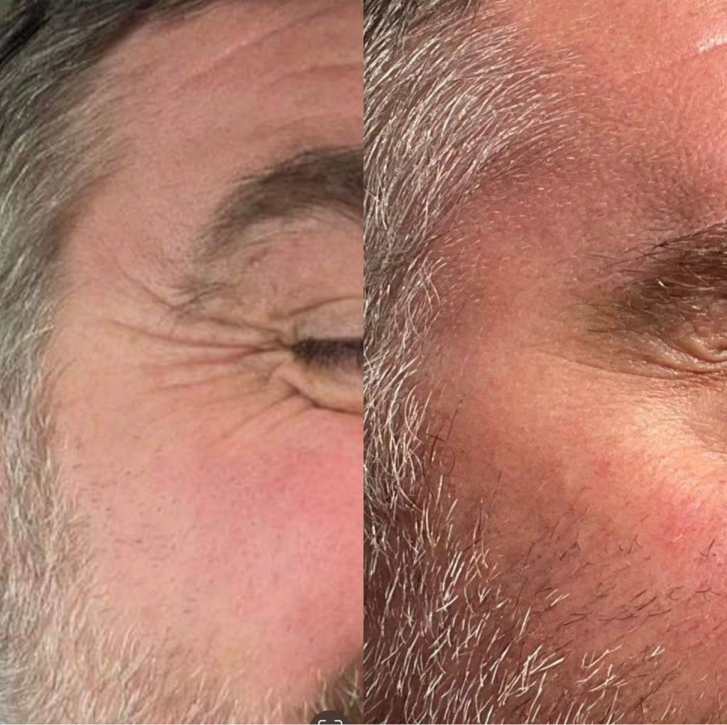 Wrinkle relaxing injections