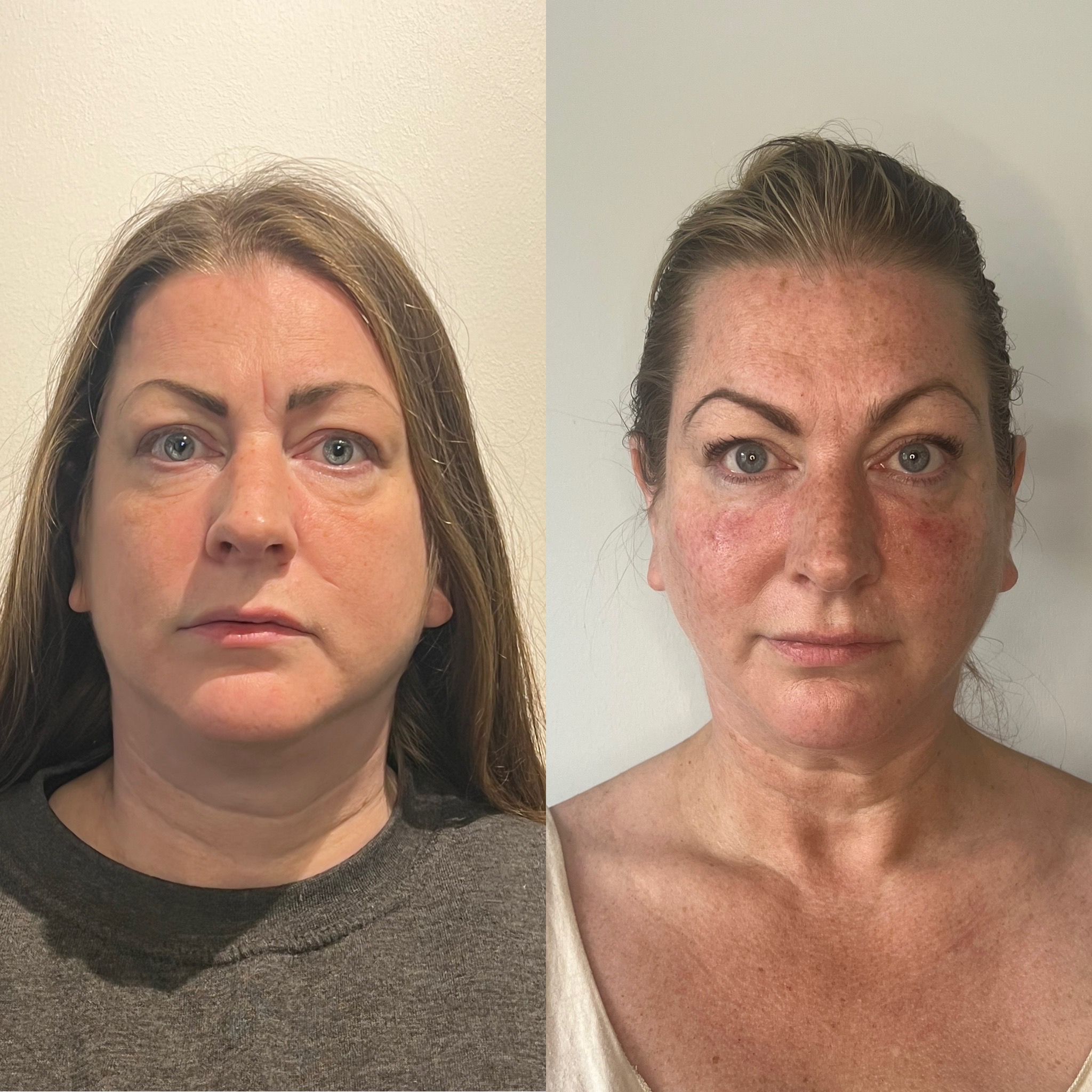 Facial fillers before and after